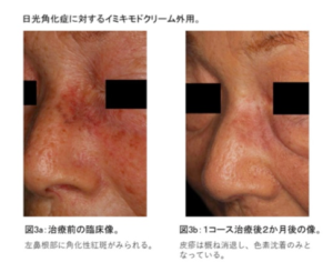 日光 角 化 ストア 症 日焼け 止め