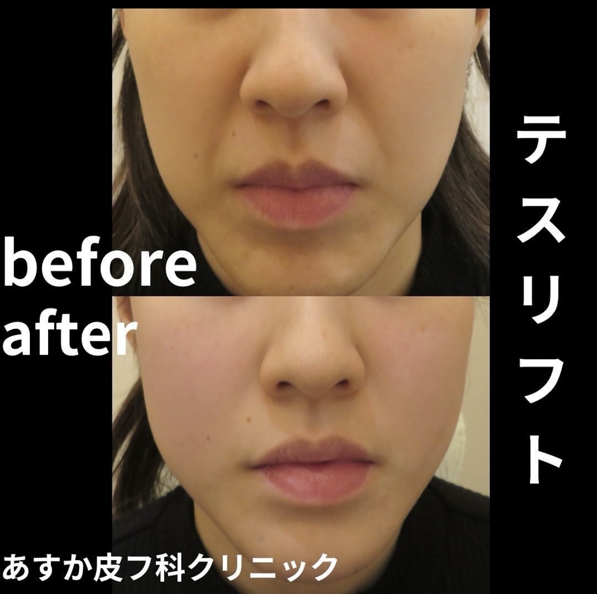 テスリフト症例📸③ | 名古屋市緑区の皮膚科・美容皮膚科は
